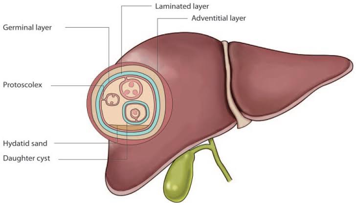 Hydatid Cyst Of Liver